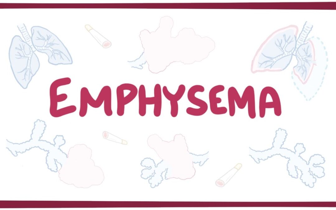 What is Emphysema? Symptoms, Causes, and Treatment